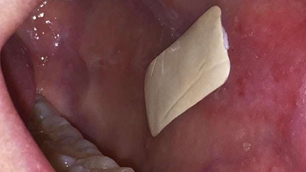 This sticky patch adheres directly to mouth ulcers and delivers steroids