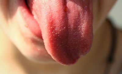 Four Types of Tongue Bacteria helps in the diagnosis of early-Stage Pancreatic Cancer